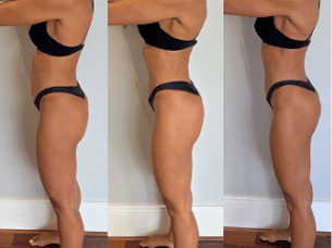 Image (Pós operatório de histerectomia — antes e depois)