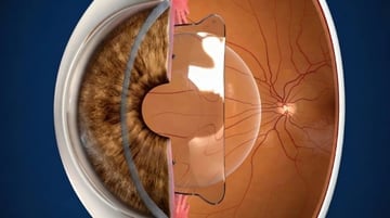 Lente fácica / ICL posicionada intraocular proporcionando visão nítida e confortável