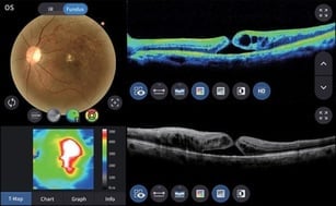 Exame de OCT da retina mostrando edema macular , buraco macular