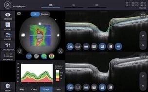 Exame de OCT da retina mostrando nervo óptico