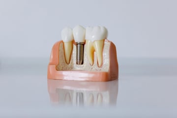 Implante dentário de titânio, estrutura utilizada no tratamento pelo Dr. Roney de Paula