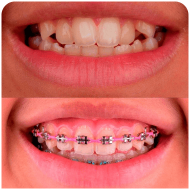 Link → Aparelho Dental - Odontoclinic