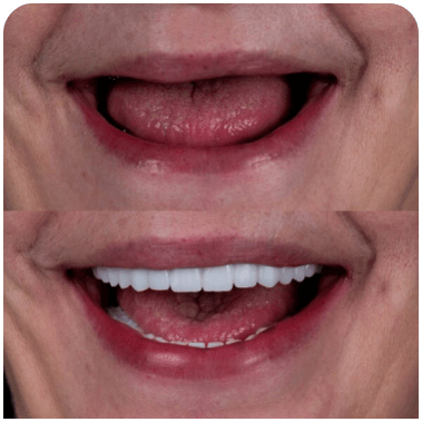 Link → Implante Dental - Odontoclinic