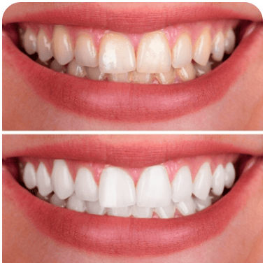 Link → Clareamento Dental - Odontoclinic